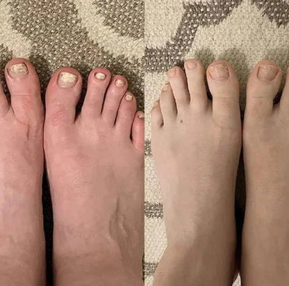 Nailyne™  UV Nail Fungus Treatment Device