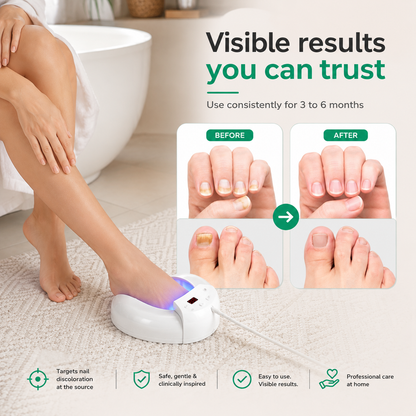 Nailyne™  UV Nail Fungus Treatment Device