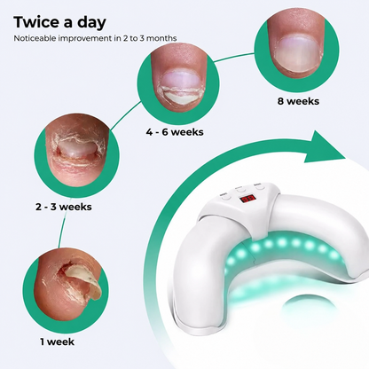 Nailyne™  UV Nail Fungus Treatment Device