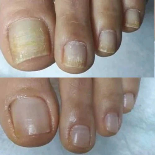 Nailyne™  UV Nail Fungus Treatment Device