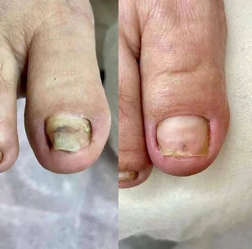 Nailyne™  UV Nail Fungus Treatment Device