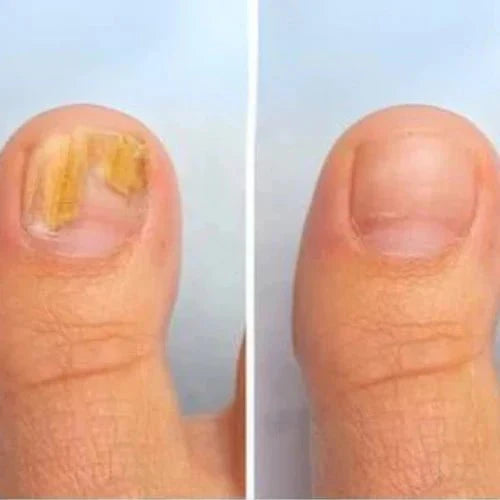 Nailyne™  UV Nail Fungus Treatment Device